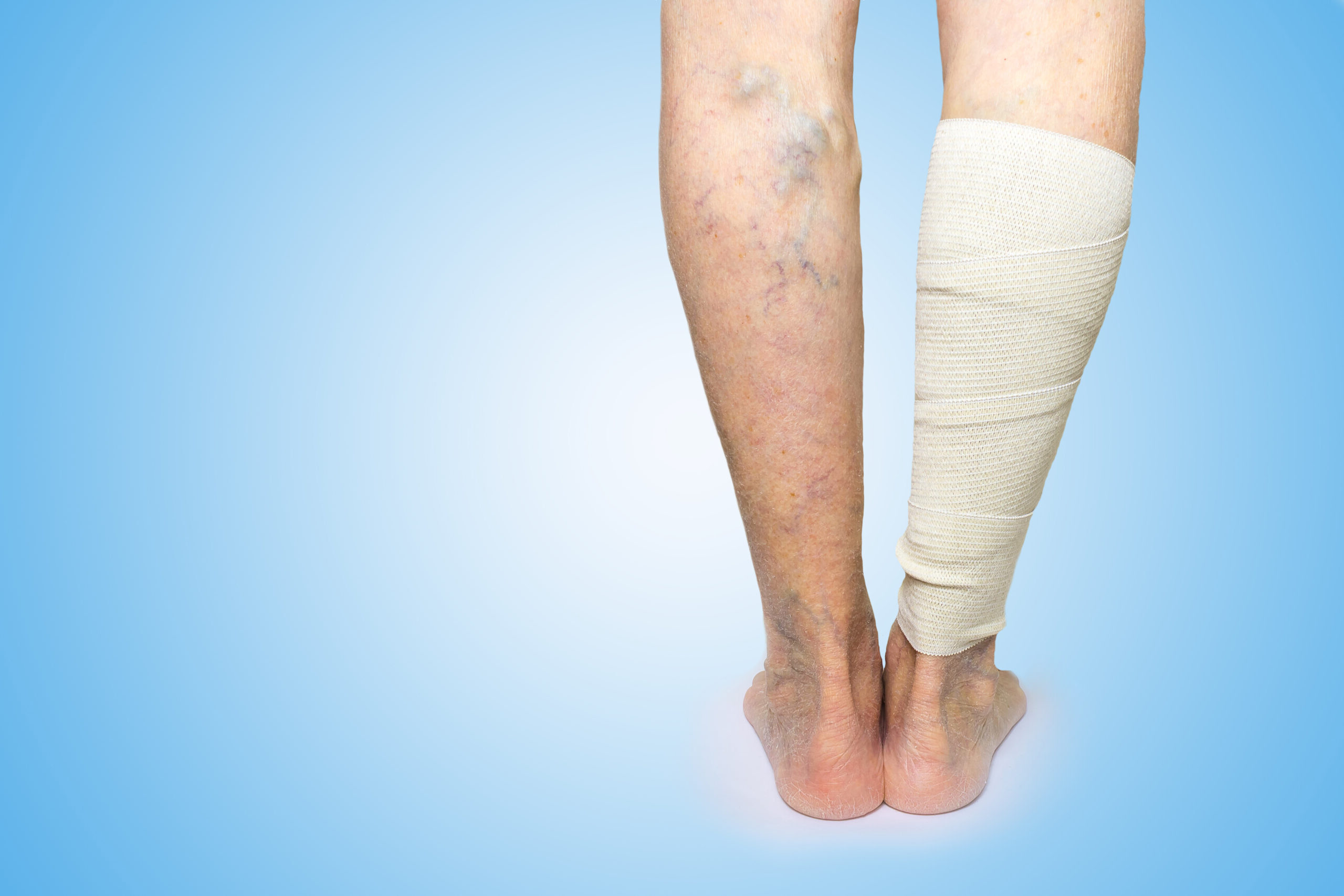 Surgical treatment of lower limb varicose veins