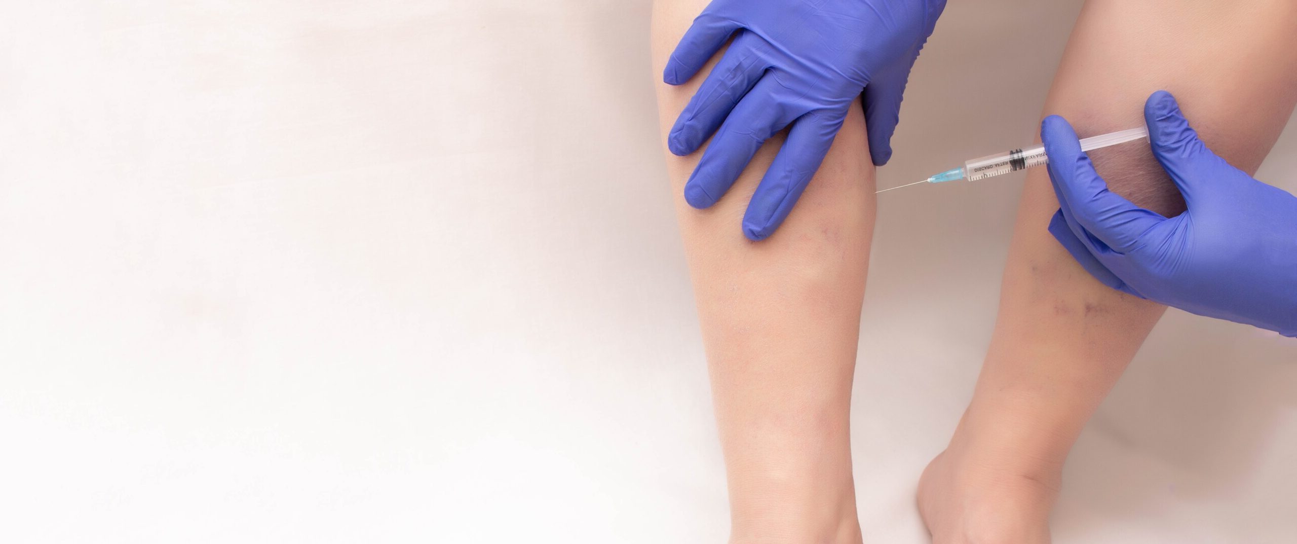 varicose vein treatment with sclerotherapy