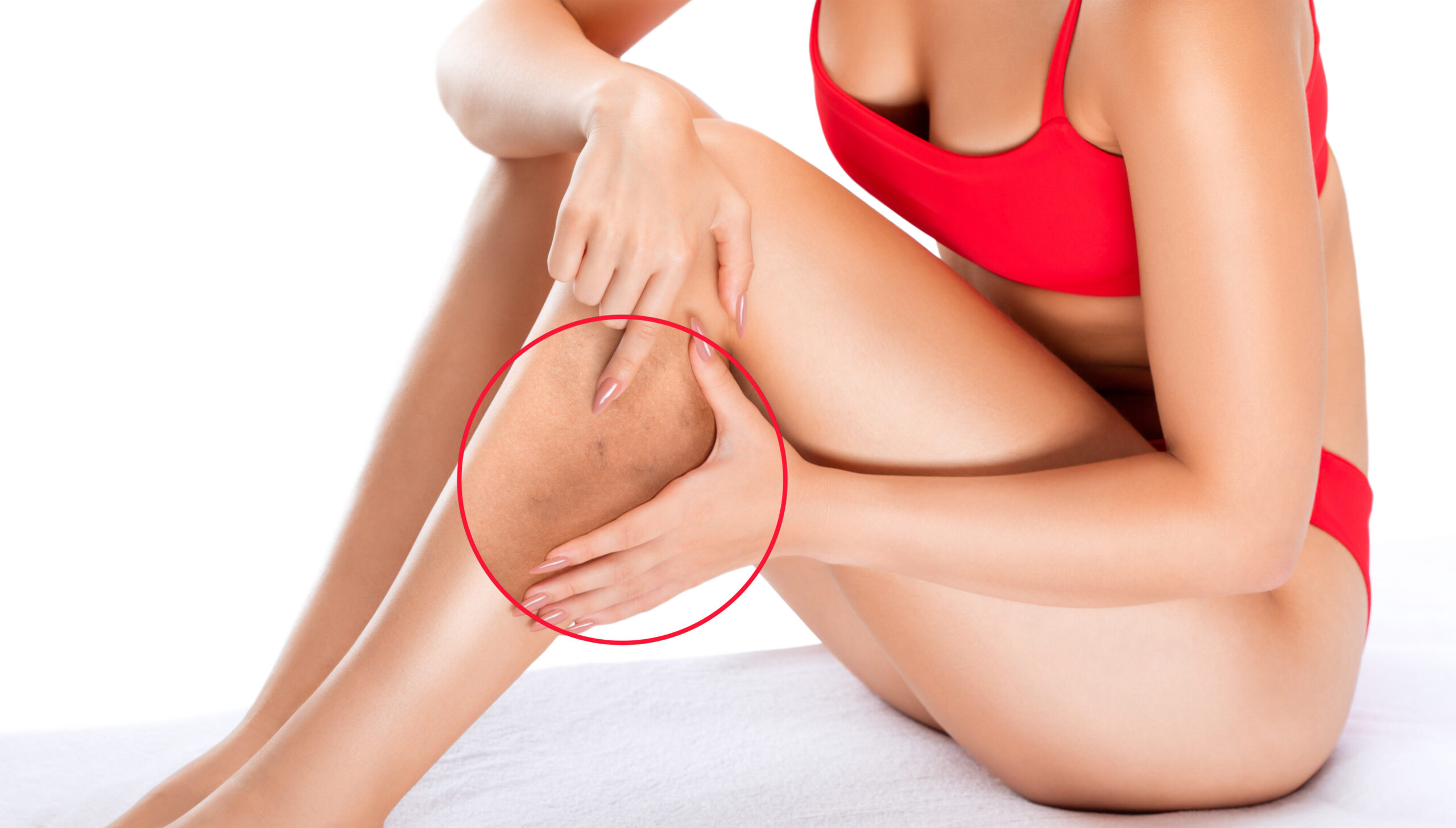 varicose vein removal using EVRF