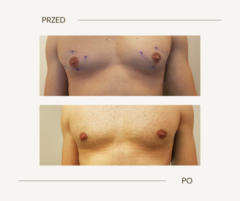 Gynecomastia removal
