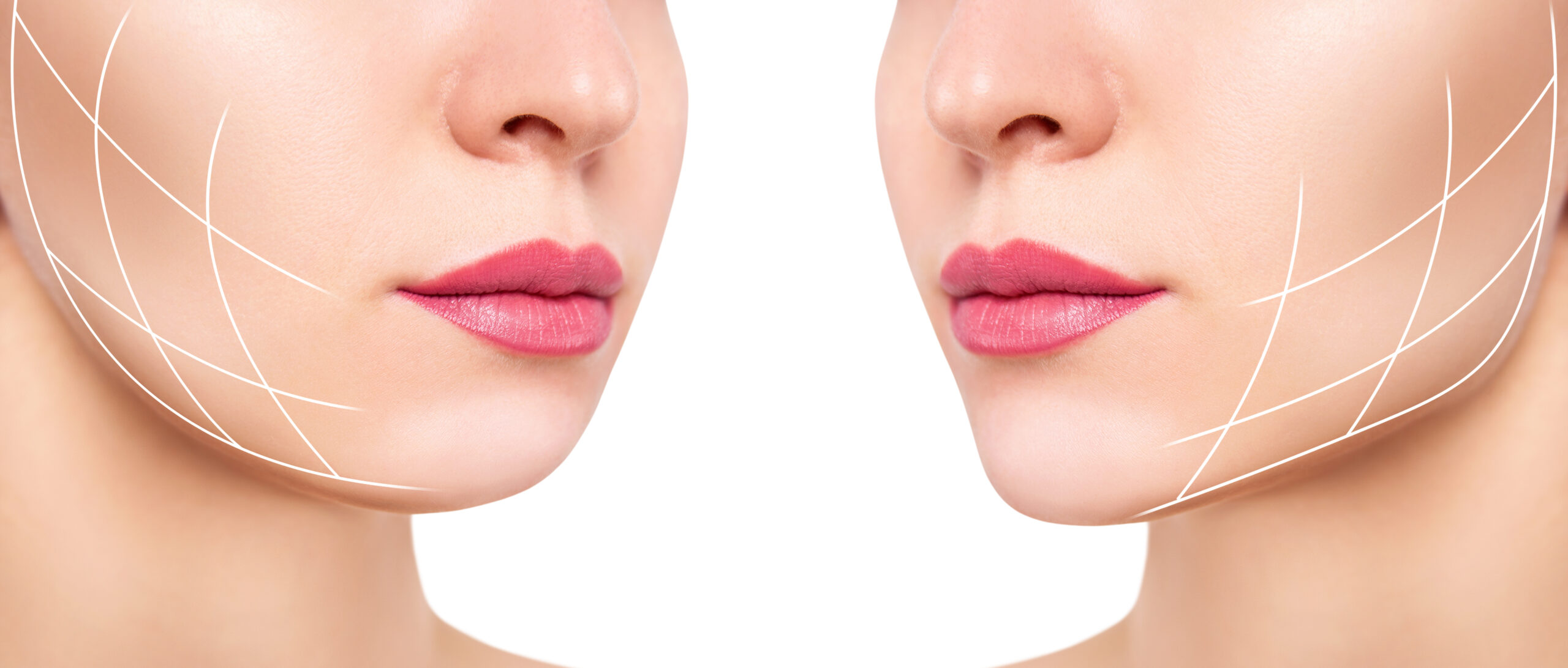 chin liposuction Wilmed